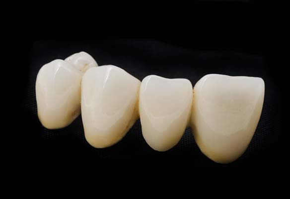 What Are Your Dental Bridge Options?