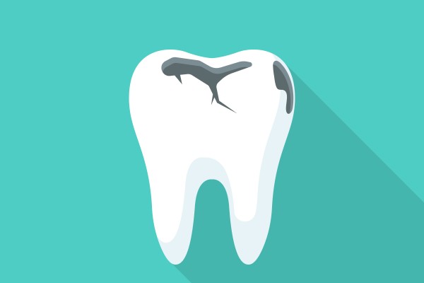 Common Signs That You May Need Dental Fillings
