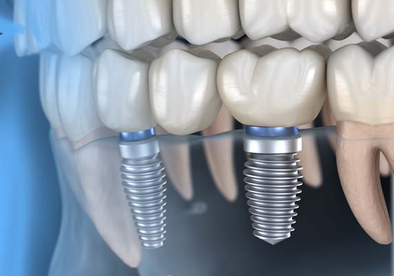 Reasons To Choose Dental Implants For Missing Tooth Replacement