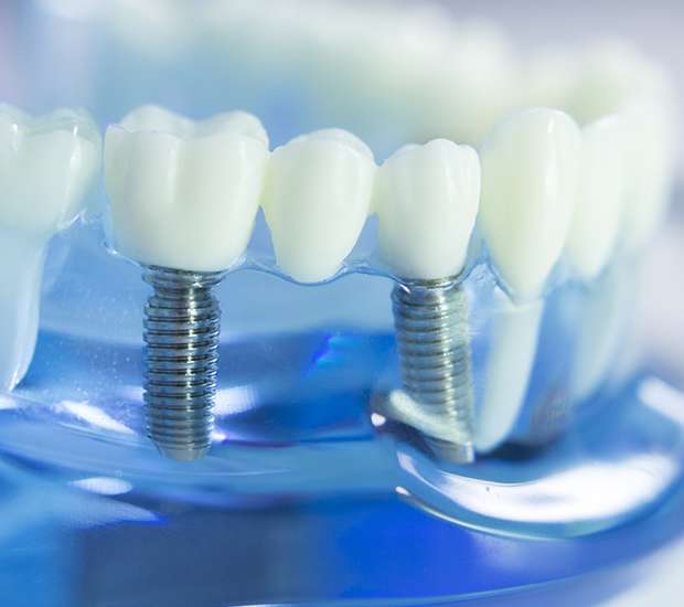 Santa Cruz Dental Implants